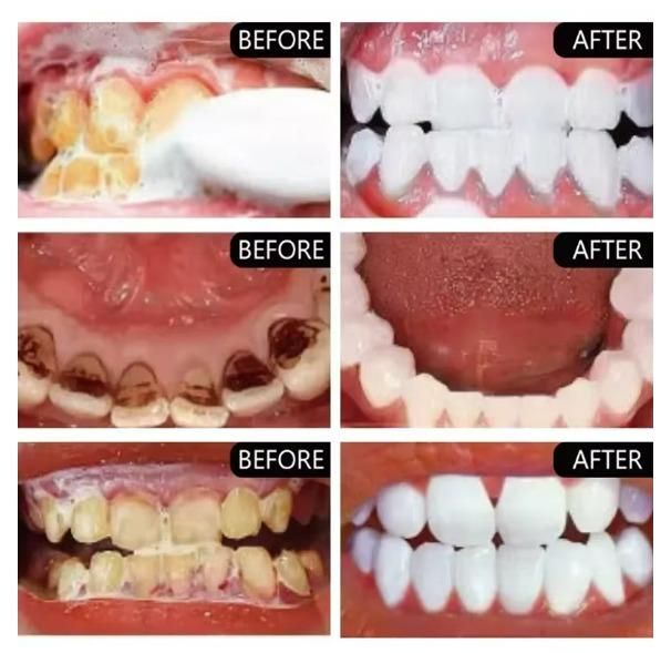 BrightSmile™ Stain-Removal Toothpaste – Instantly Whitens Teeth (Pack of 2)