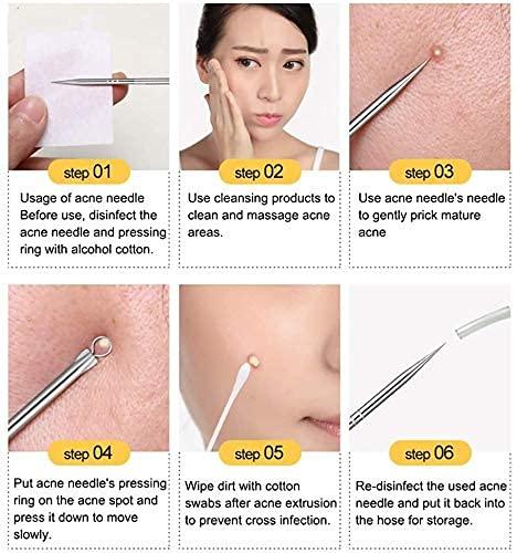 ClearSkin™ Stainless Steel Blackhead & Acne Extractor Set (4 Pcs) – Instant Pore Cleansing