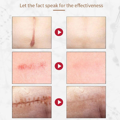 Kurai™ Scar Removal Cream Gel – Advanced Acne Spot, Stretch Mark & Burn Repair Treatment